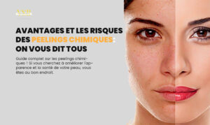 Avantages-et-les-risques-des-peelings-chimiques-On-vous-dit-tous